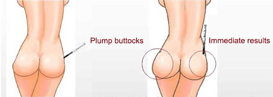 Hyaluronate-injection-buttocks